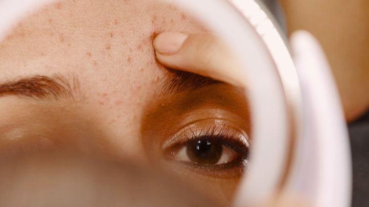 Can you get rid of a pimple overnight? 4 products to help get rid of acne fast